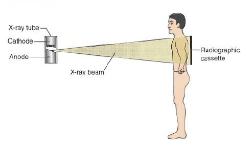 x-ray AP view