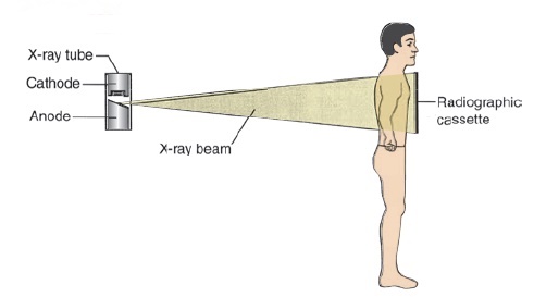 x-ray PA view