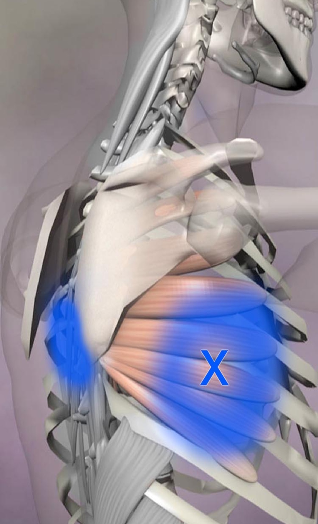 serratus anterior trigger point and referral pain pattern