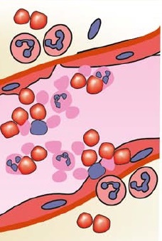 Acute_inflammation