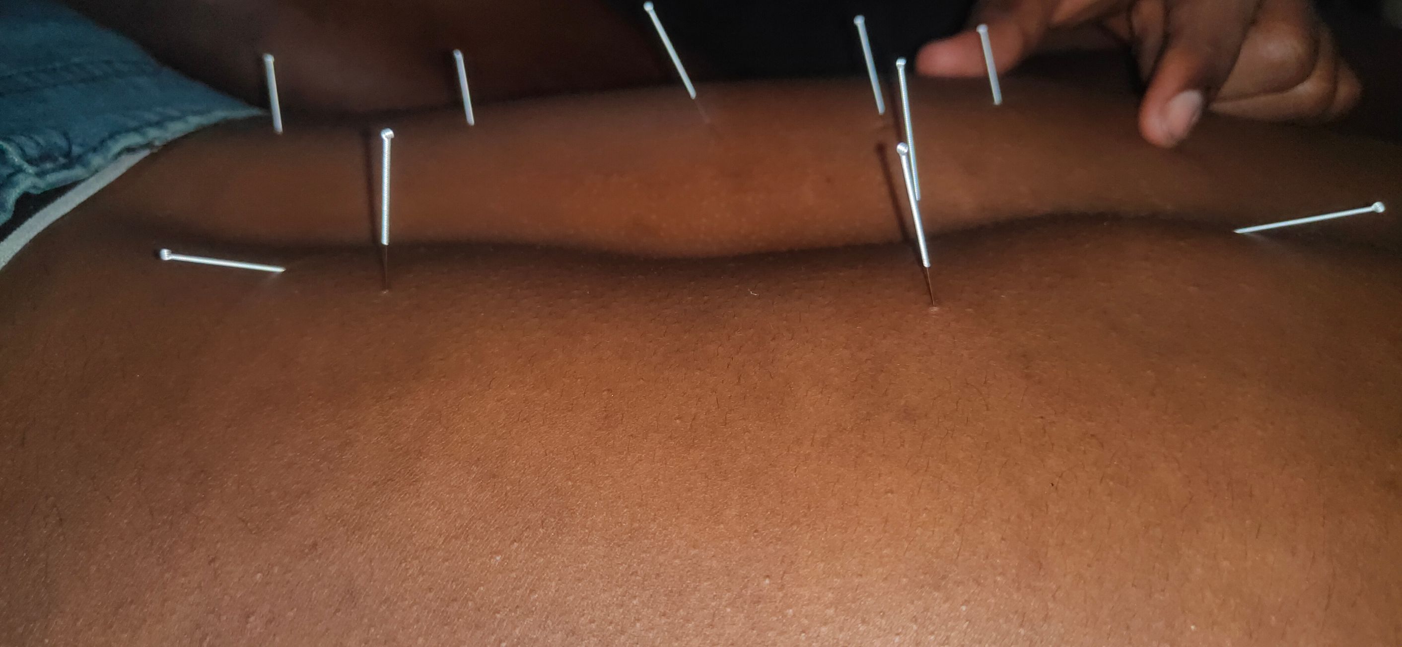 Dry_needling_therapy